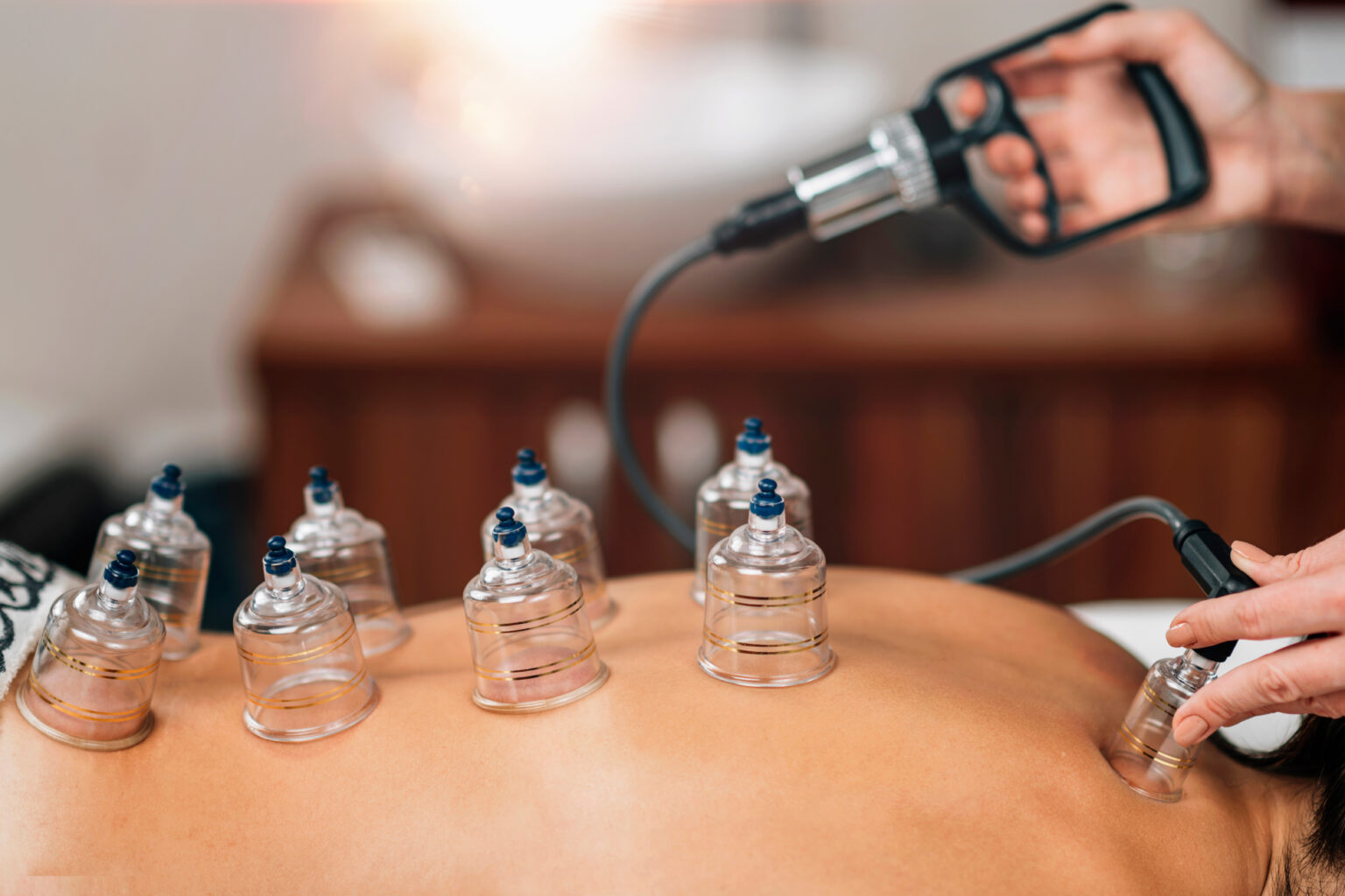 Glass cupping cups on a client's back with a hand-held suction pump