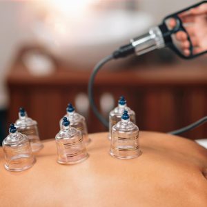Cupping therapy - traditional Chinese medicine